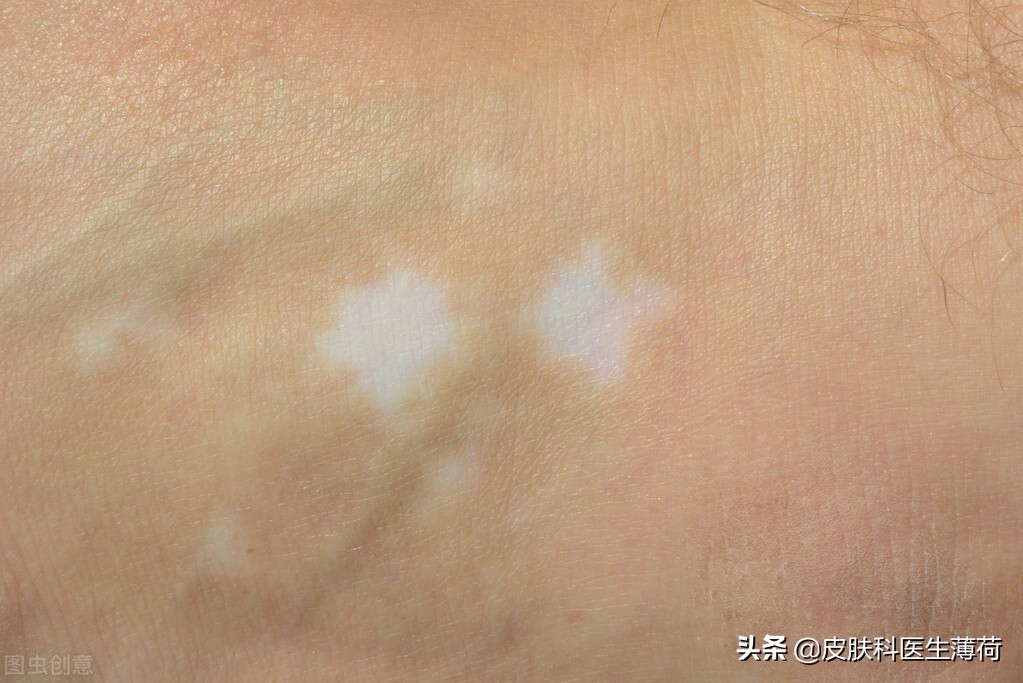 0成本脸色暗沉发黄如何快速美白,皮肤暗沉怎么样才能快速美白