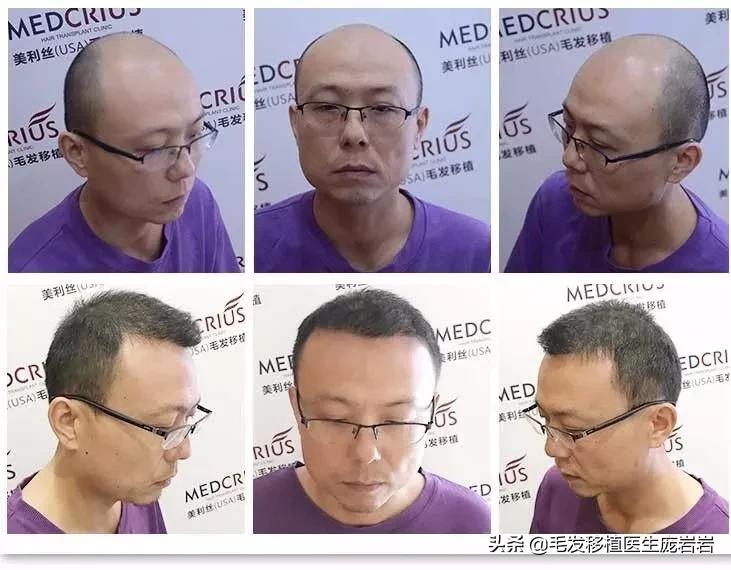 做这个动作轻松改善,做什么操可以防止脱发