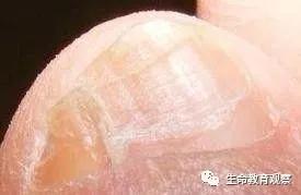 为什么中国人的小脚趾有两瓣,为什么中国人的脚趾甲是两半的