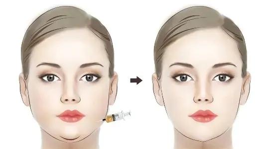 韦敏颧骨内推和削下颌角总费用,韦敏下颌角截骨