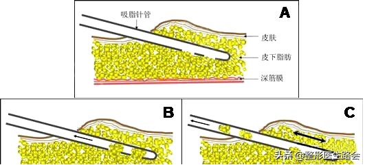 下颌角整形│对不起,你的脸让我的心好“方”