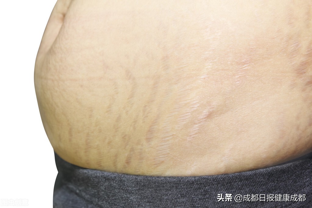 如何抚平烧伤疤痕,怎么去除厚厚的烧伤疤痕增生