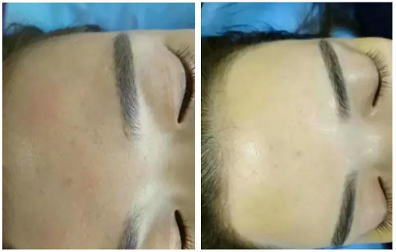 现在美容最火项目,激光脱毛品牌推荐美容院