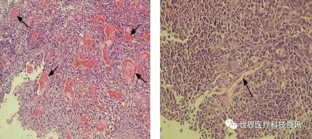 疟原虫治疗癌症叫停,疟原虫治疗癌症最新消息