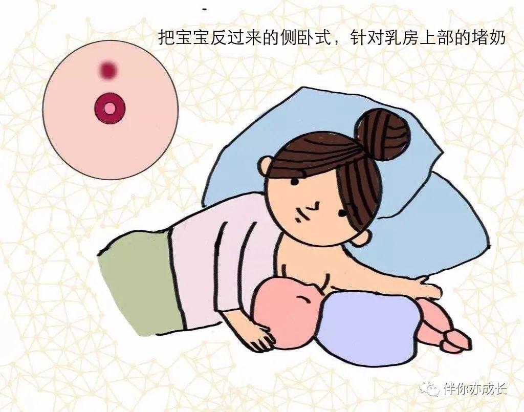 堵奶如何处理最有效,乳腺管不通奶堵怎么处理