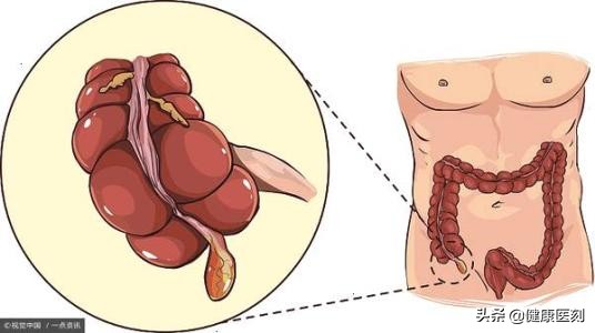 粑粑颜色是深褐色的是什么原因,绿色粑粑是癌症吗