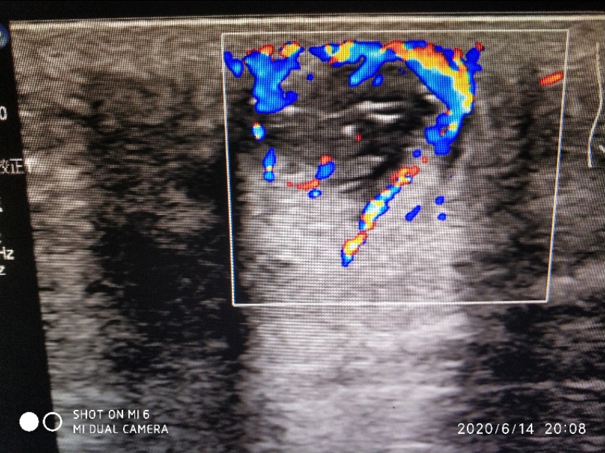 骶尾部囊肿手术多久可以弯腰,骶尾部囊肿和藏毛窦哪个严重