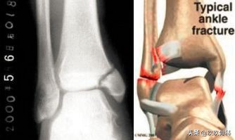 陈旧性踝关节损伤的治疗,踝关节损伤现场处理视频