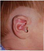 耳廓畸形高考生体检怎么办,二度耳廓畸形矫正方案