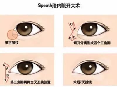 开内眼角会遗留明显疤痕吗,十个开眼角十个留疤