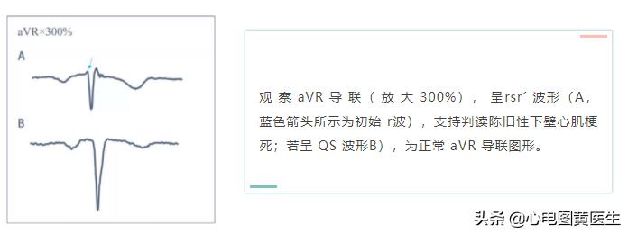 心电图q波异常但冠脉造影正常,病理性q波与异常q波心电图