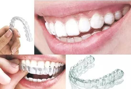 拔牙做隐形正畸常见问题,helen齿科