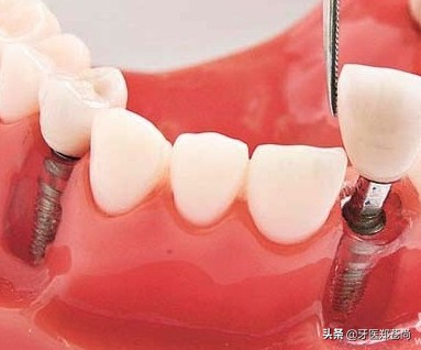美格种植牙效果怎么样,滨州正规种植牙哪种效果好