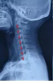 颈椎生理曲度变直如何快速治疗,颈椎变直好治吗