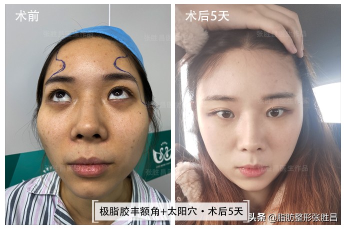 颧骨高只能颧骨内推？她怕开刀磨骨创伤大，仅做脂肪填充就改善了