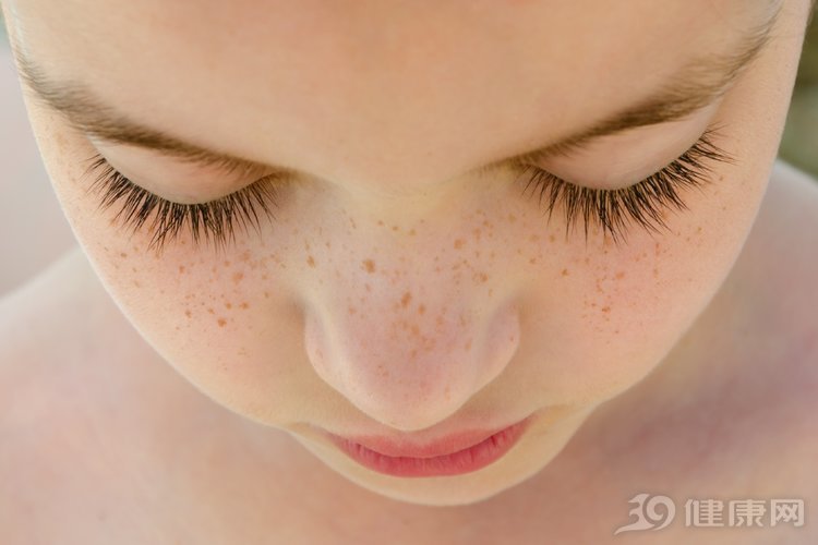 祛斑最好的方法去除老年斑,脸上长褐斑怎么祛斑