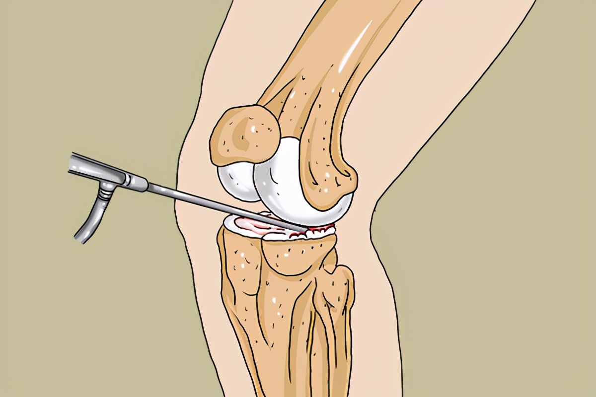 骨折上了钢板有炎症需要取钢板,骨折上钢板与取钢板哪个痛苦轻