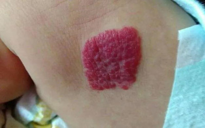 血管瘤破裂后医生说没治了,血管瘤结痂是自愈吗