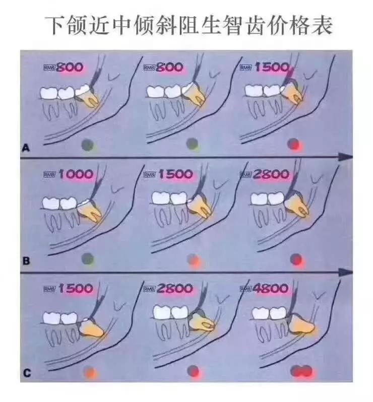 埋得越深，分手费越高——你所不知道的拔智齿收费依据