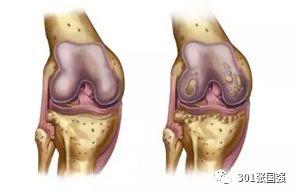 老年膝骨关节炎可以治愈吗?