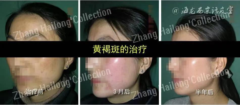 褐斑怎么办,褐斑能彻底去除吗