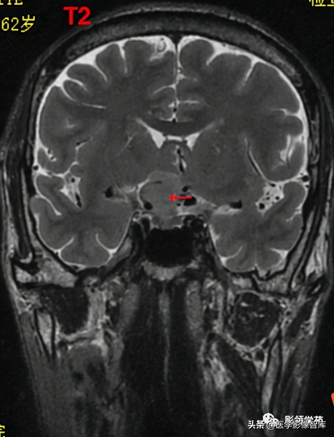 鞍区肿瘤做什么检查得出来,鞍区肿瘤的影像学鉴别