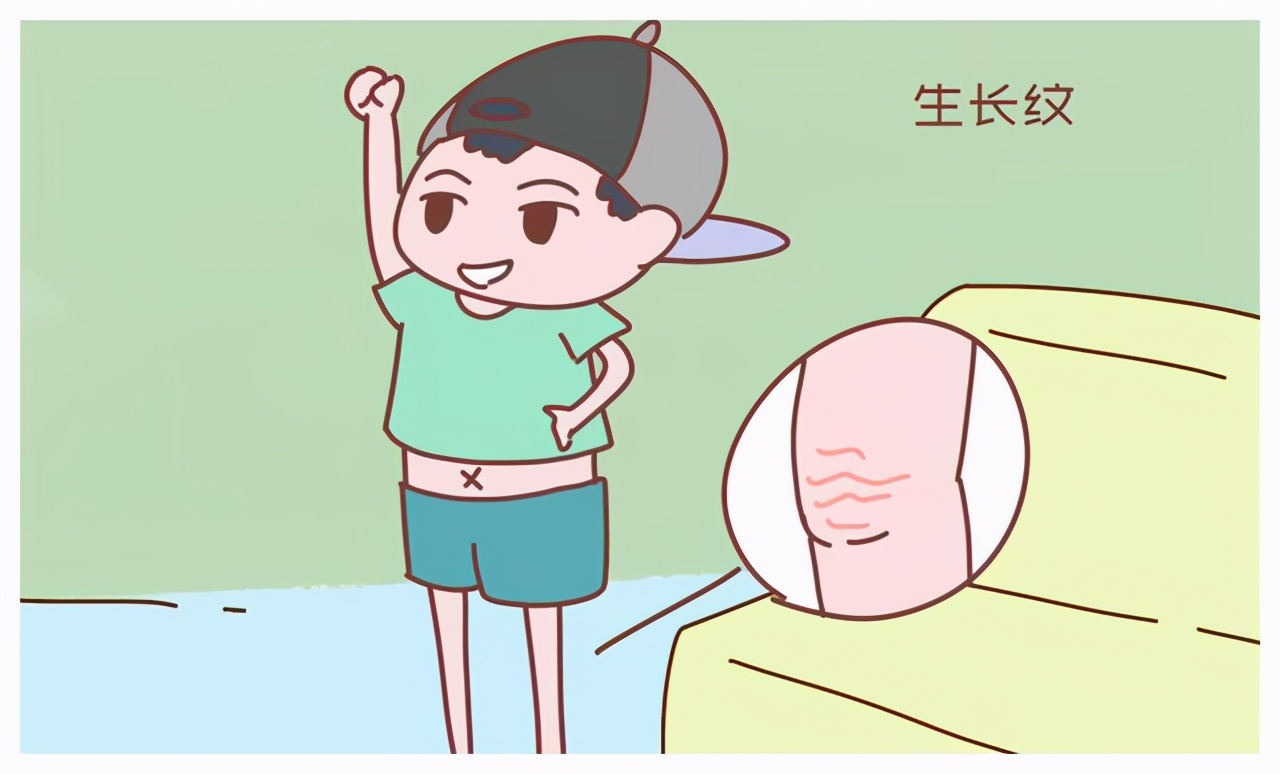青少年会长妊娠纹吗,青少年膝盖有妊娠纹怎么回事