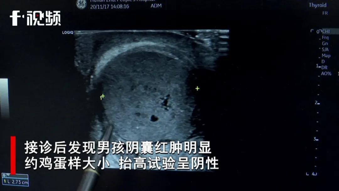 湖南一男童*体下**疼痛被误当感冒，错过黄金救治时间*丸睾**不保