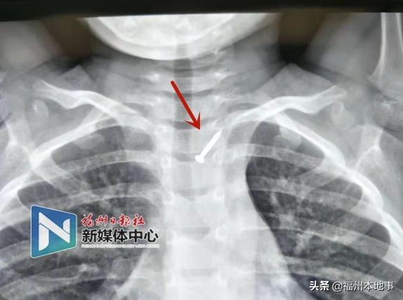 幼童误吞钉子,孩子误吞4厘米钉子