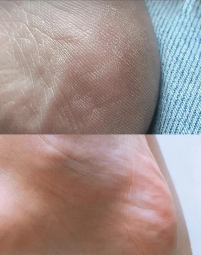 一招教你解决脚后跟干裂起皮,治理脚后跟干裂脱皮的小妙招