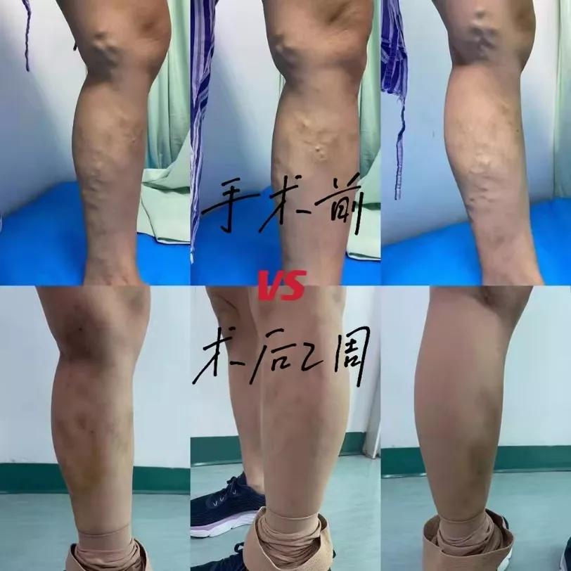 激光治疗腿部静脉曲张的视频,激光静脉曲张手术后腿肿胀