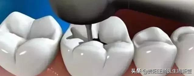 牙釉质缺损是什么样子,牙釉质缺损可以自己恢复吗