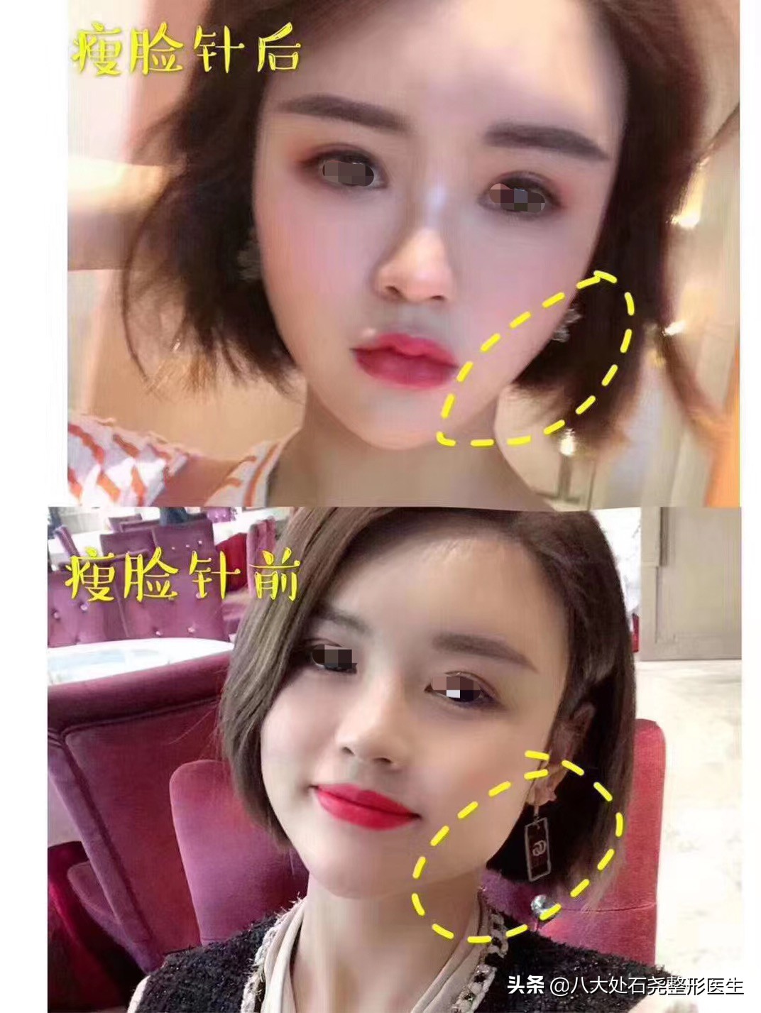 瘦脸针后苹果肌下垂凹陷能恢复吗,你有脸部下垂的烦恼吗