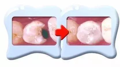 牙齿烂了一半为什么不能补牙,牙齿缺了一半补牙要多少钱