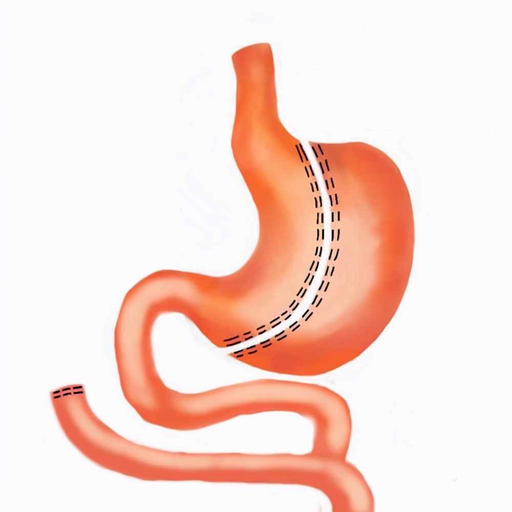 胃癌患者注意事项,治疗胃癌需要注意的细节问题