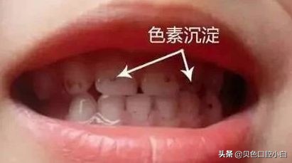 宝宝牙齿黄黄的刷不干净怎么办,宝宝不爱刷牙牙齿黑了怎么办