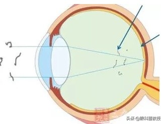 飞蚊症是什么原因引起的怎么治好,高度近视引起的飞蚊症可以治疗吗