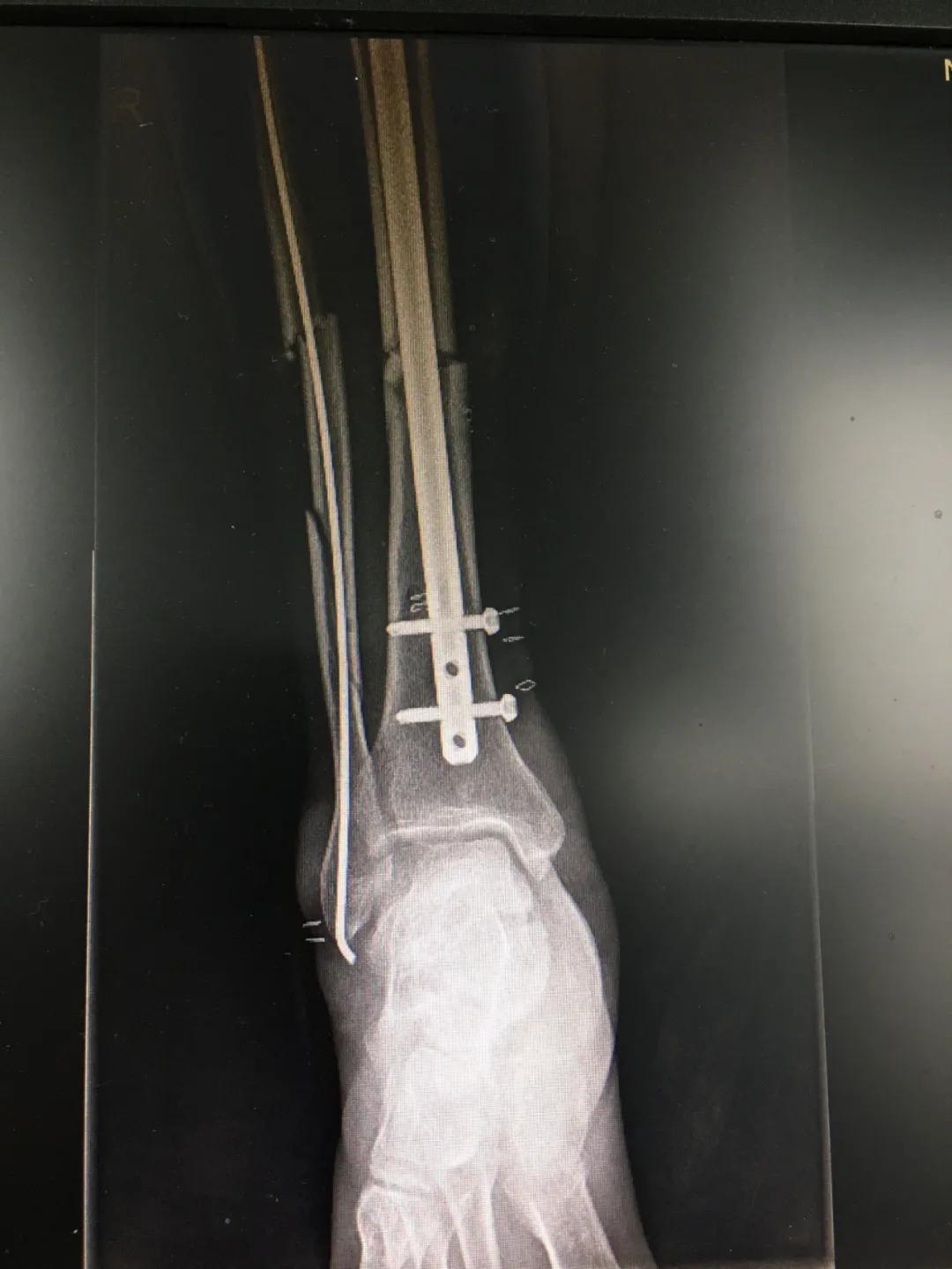 小腿挤压大量淤血能在家自愈吗,小腿碎成三截还能复原吗