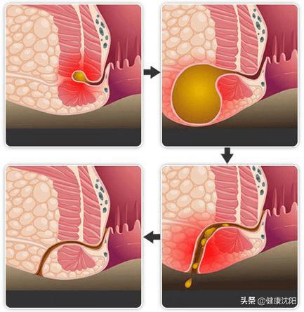 健康科普堂|治肛周脓肿绝肛瘘之后患无穷