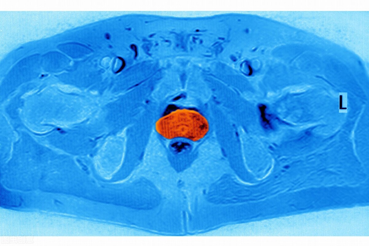 最新治疗前列腺癌的新疗法,晚期前列腺癌治疗你需要知道的事