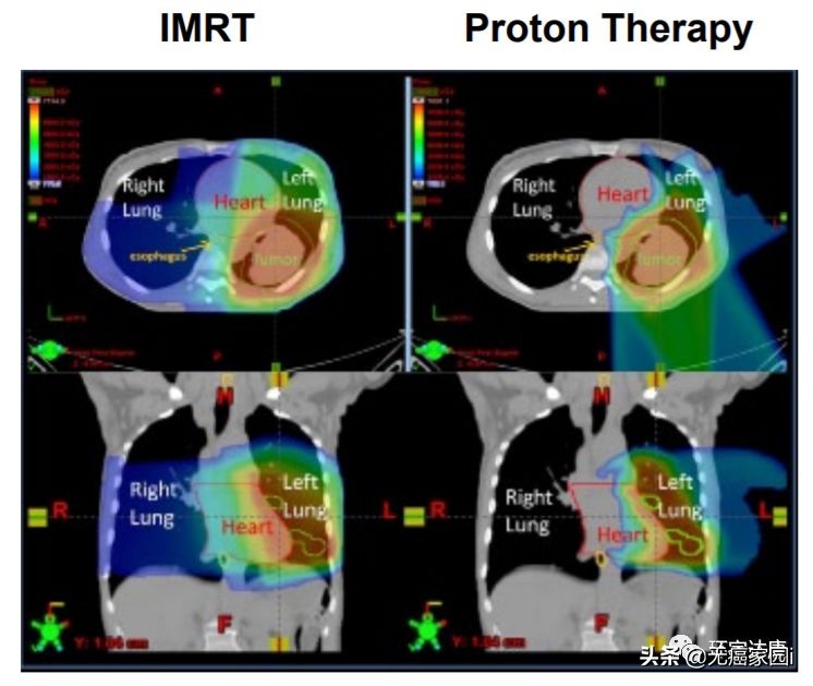肺癌手术后质子治疗,肺癌放疗30次食道损伤能恢复吗