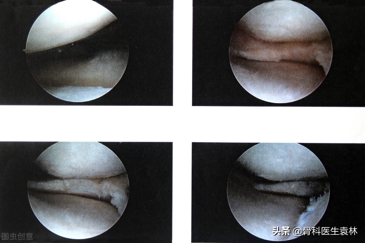 半月板缝合手术后多久可以正常走路？这3种情况需注意
