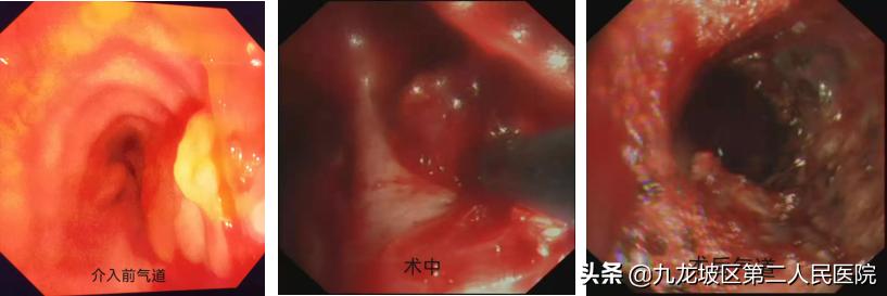 你知道支气管淀粉样变吗?82岁大爷在手术台上竖起了大拇指