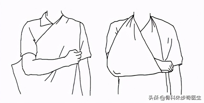 小孩锁骨骨折医生建议保守治疗,儿童锁骨骨折症状恢复案例