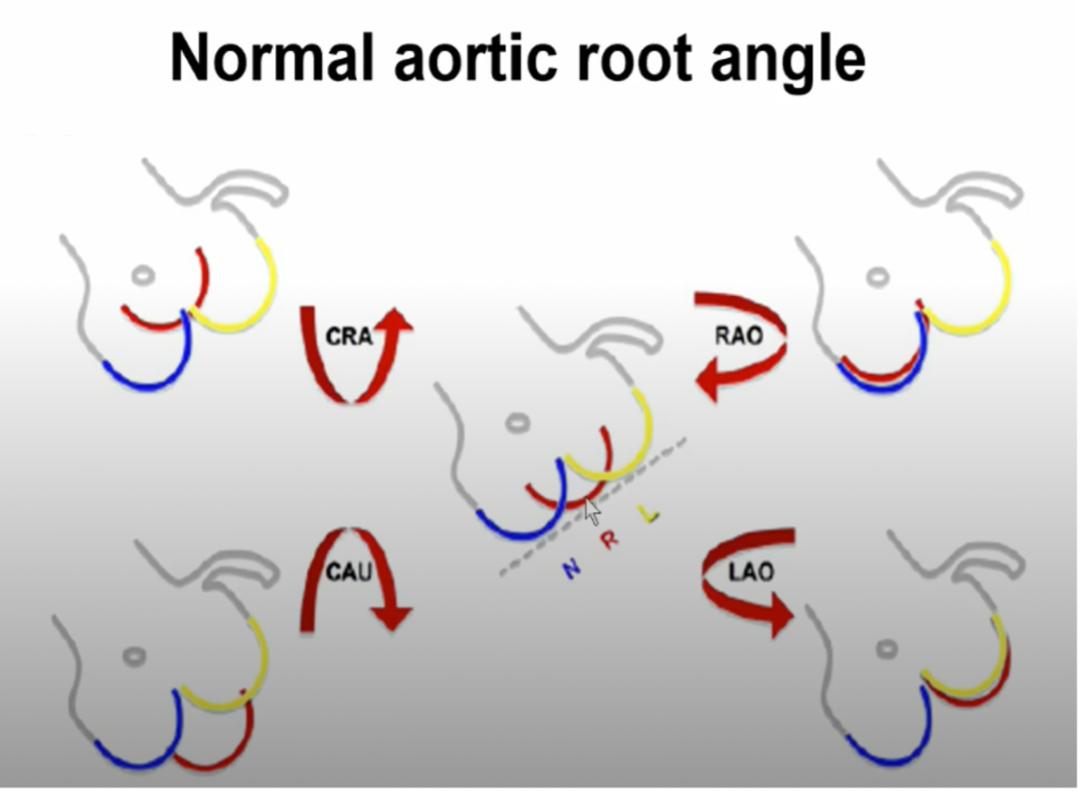 对造影剂过敏如何进行介入治疗,造影剂过敏迟发性治疗