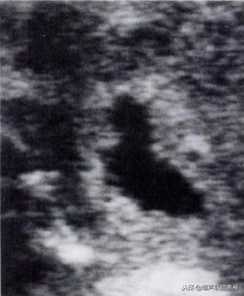 内见卵黄囊,卵黄囊肿瘤