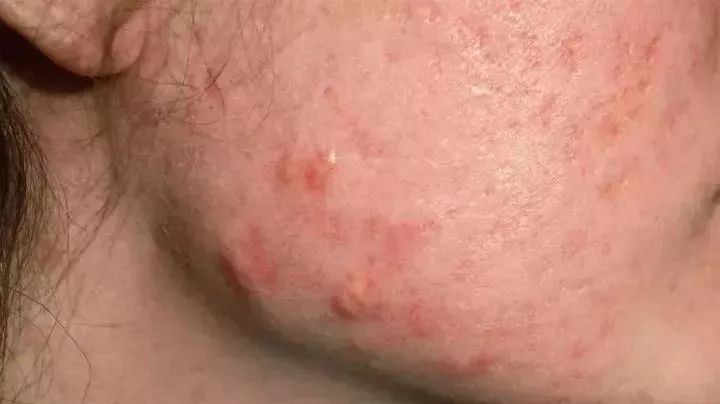 疮是怎么引起的怎么治,长疮的症状和表现有什么