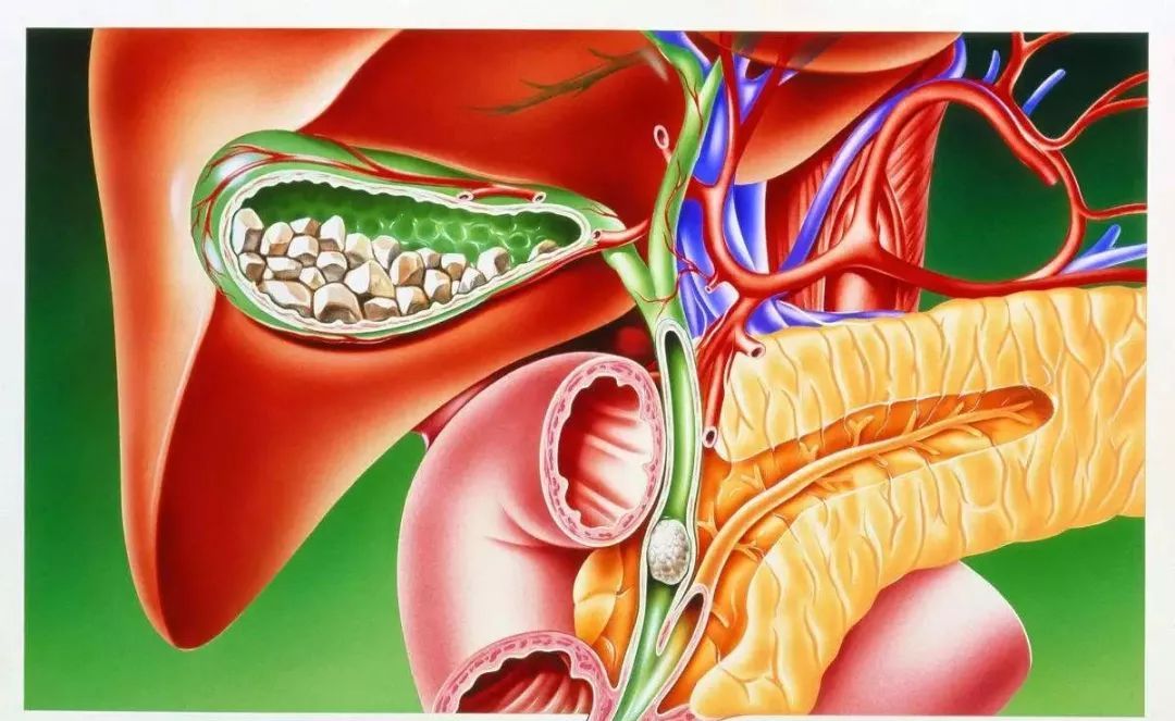 小孩有胆囊结石可以保胆取石么,儿童胆囊结石可以保胆取石吗
