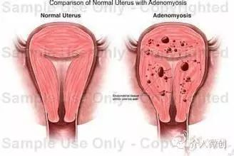 从手上扎针插管就能治子宫腺肌症——经桡动脉入路子宫动脉栓塞术