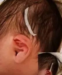 出生宝宝耳朵耳廓畸形判断,新生婴儿耳廓畸形圆耳